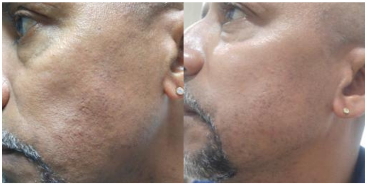 Microdermoabrasión - Clínica Estética Carvajal Panamá 2