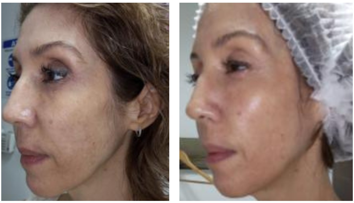 Foto Facial - Clínica Estética Carvajal Panamá 3