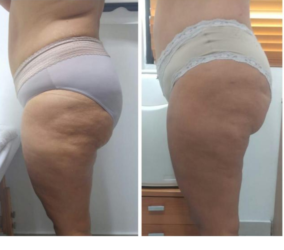 Cellulite Shock - Clínica Estética Carvajal Panamá 2