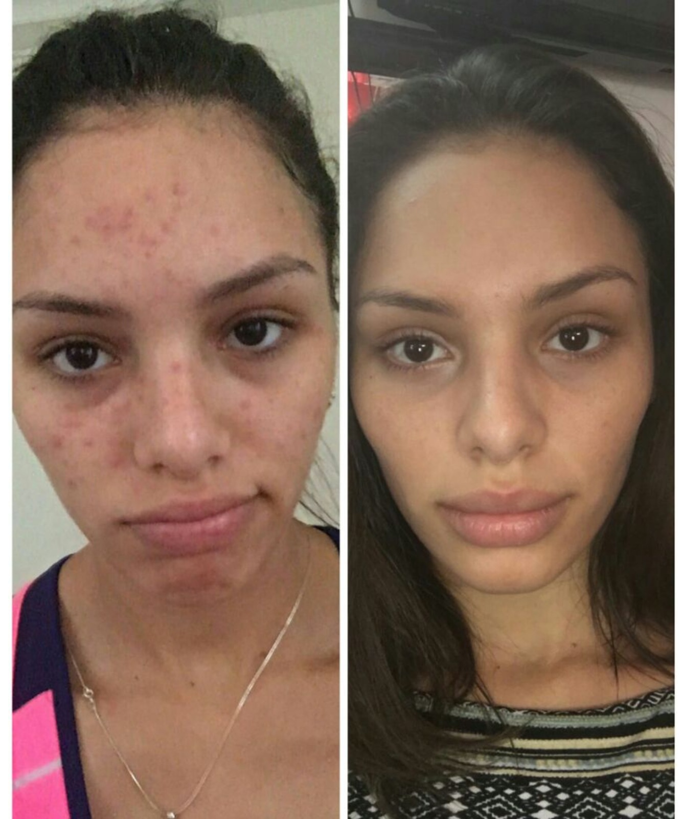 Luz Anti-Acné - Clínica Estética Carvajal Panamá 2