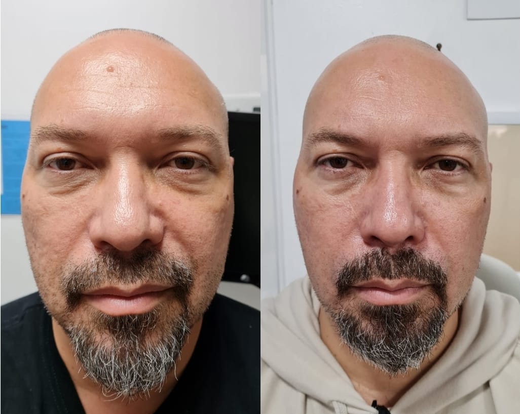 Regenerador Facial - Clínica Estética Carvajal Panamá 2
