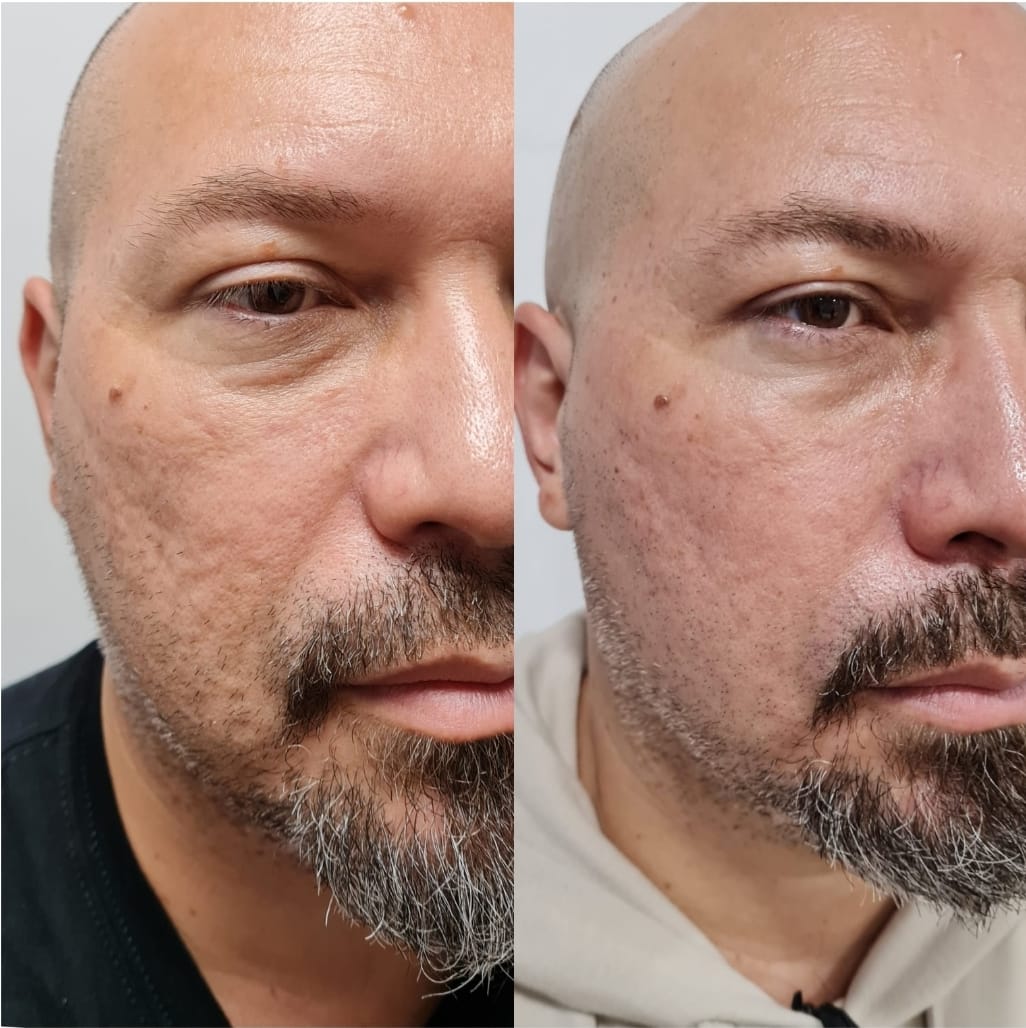 Regenerador Facial - Clínica Estética Carvajal Panamá 3