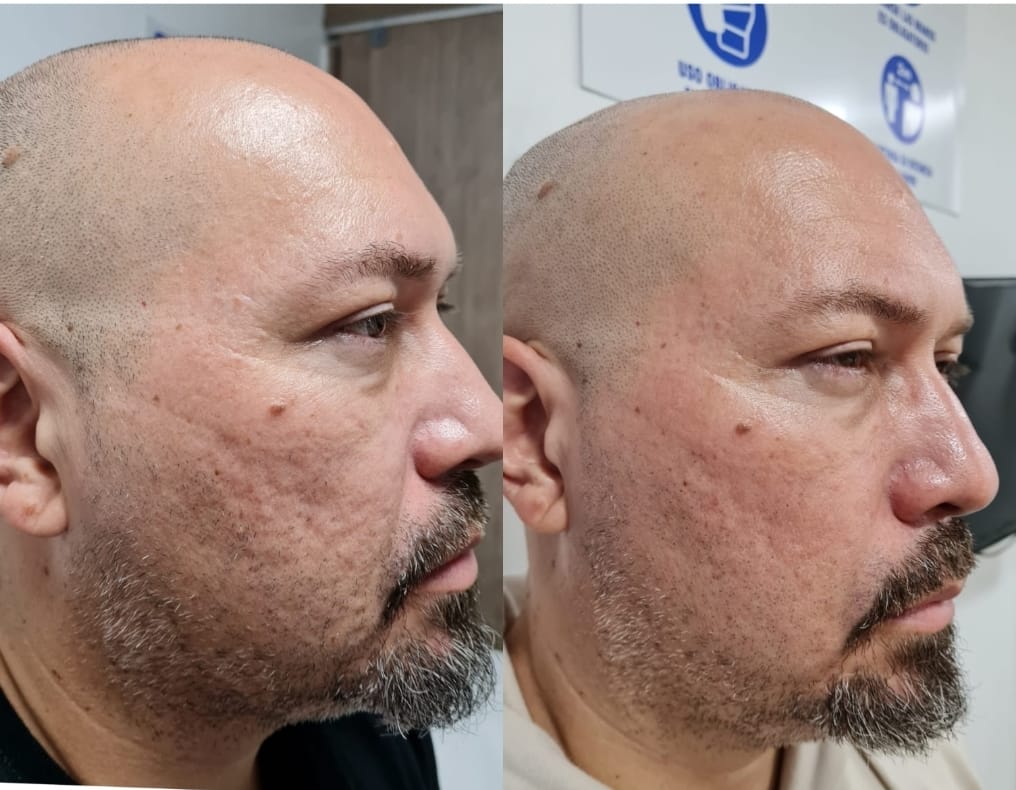 Regenerador Facial - Clínica Estética Carvajal Panamá 4