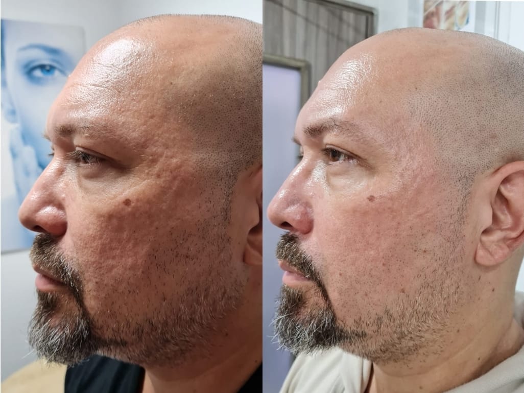Regenerador Facial - Clínica Estética Carvajal Panamá 5