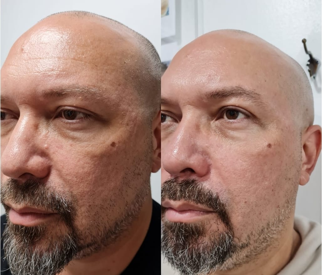 Regenerador Facial - Clínica Estética Carvajal Panamá 6