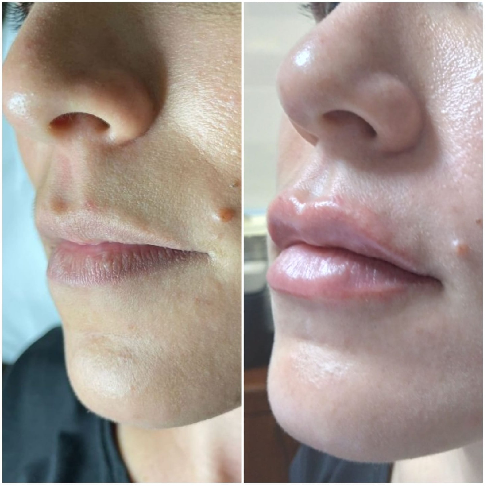 Relleno Deep - Clínica Estética Carvajal Panamá 4