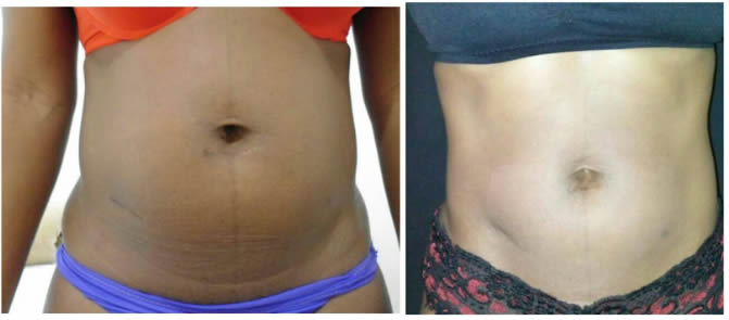 Tensor de Cuerpo - Clínica Estética Carvajal Panamá 3