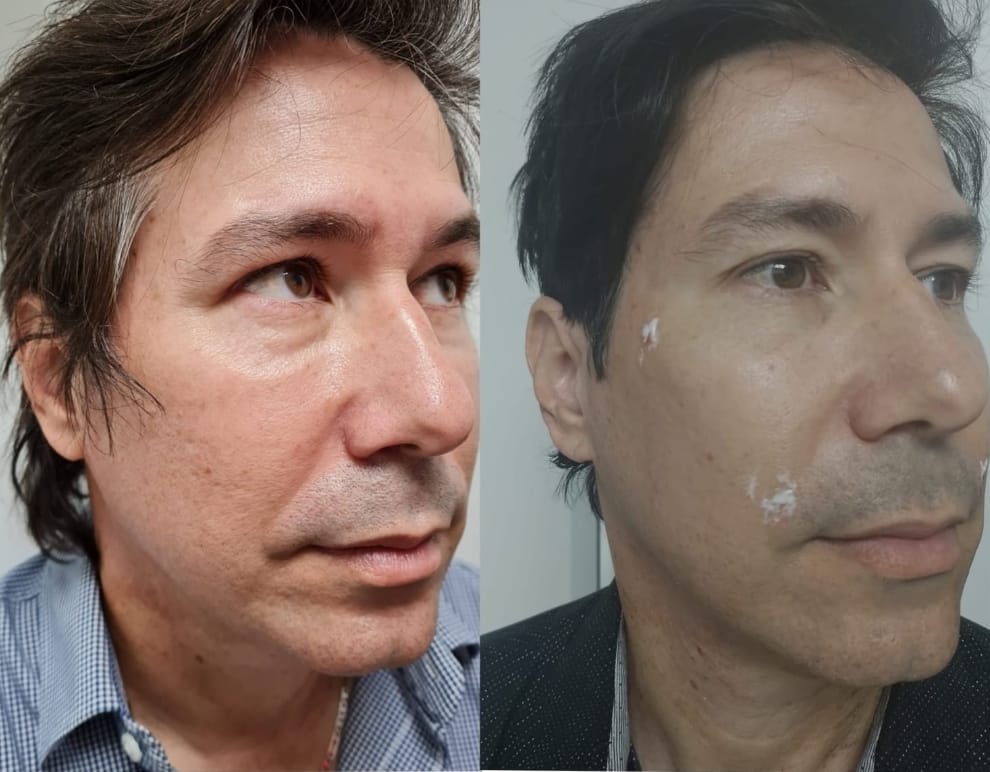 Total Make Over - Clínica Estética Carvajal Panamá 3
