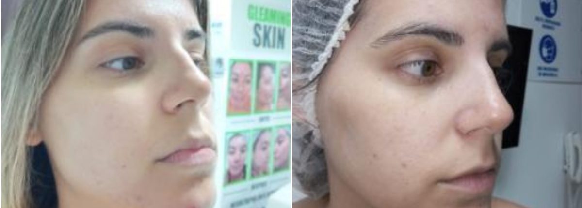 Tratamiento de Novia - Clínica Estética Carvajal Panamá 3