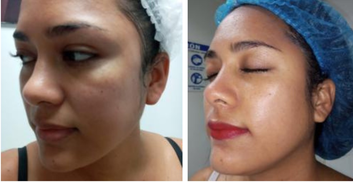 Vita C Peel - Clínica Estética Carvajal Panamá 3