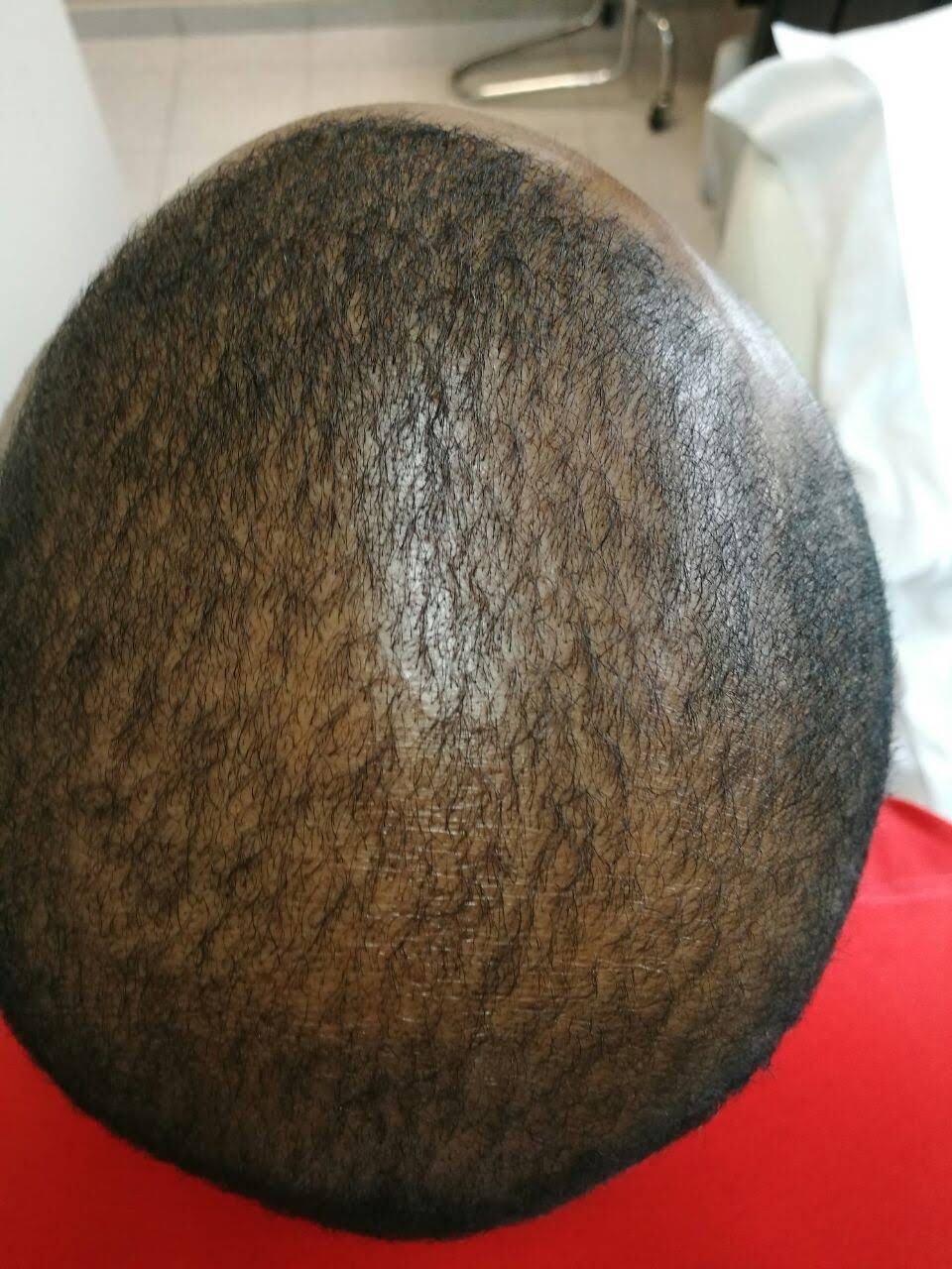 Capilar Plus - Clínica Estética Carvajal Panamá 2