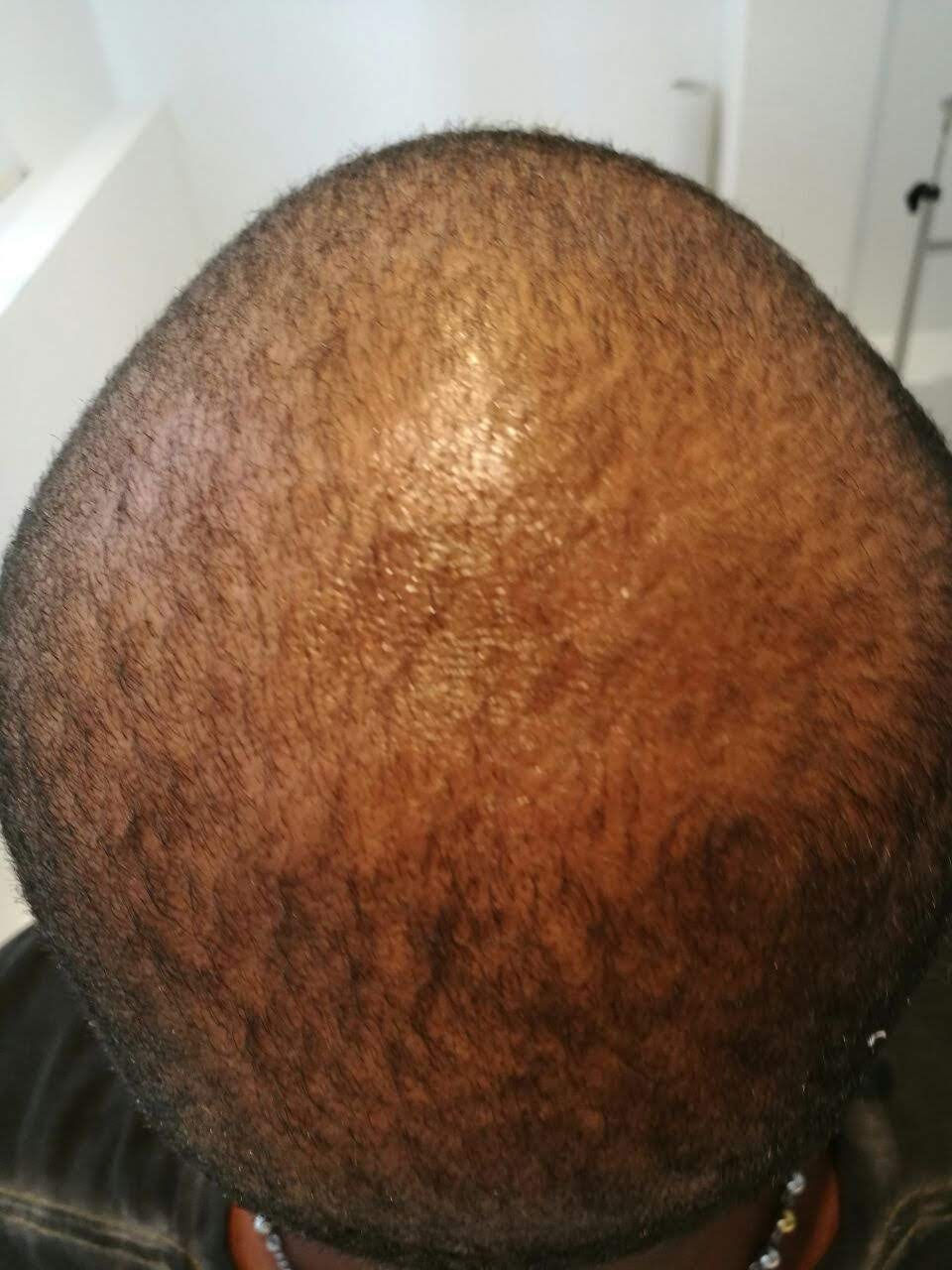 Capilar Plus - Clínica Estética Carvajal Panamá 3