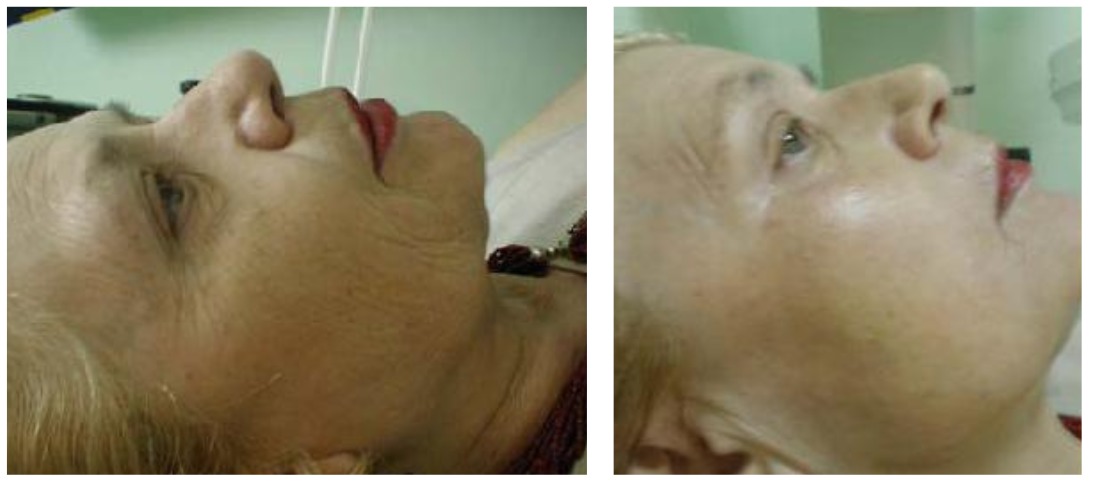 Acthyderm Rostro - Clínica Estética Carvajal Panamá 3