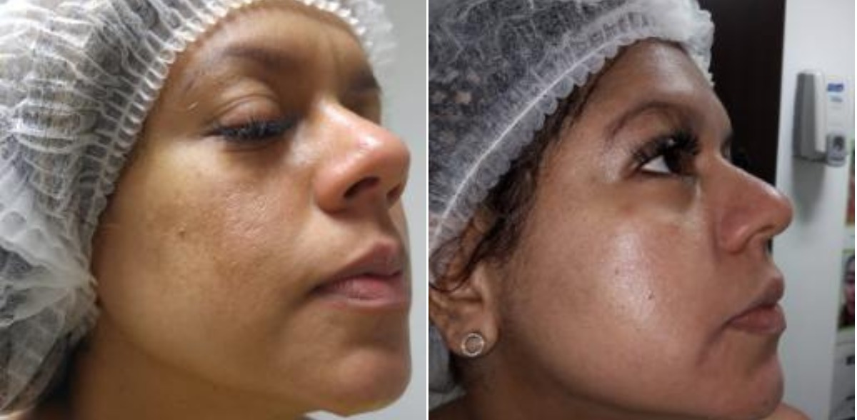 Hidrofacial - Clínica Estética Carvajal Panamá 2