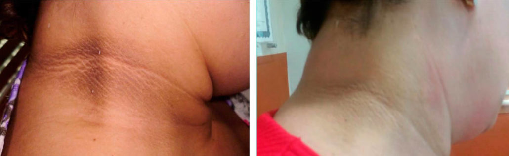 Blanqueamiento por área - Clínica Estética Carvajal Panamá 3