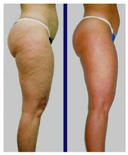 Acthyderm Cuerpo - Clínica Estética Carvajal Panamá 2