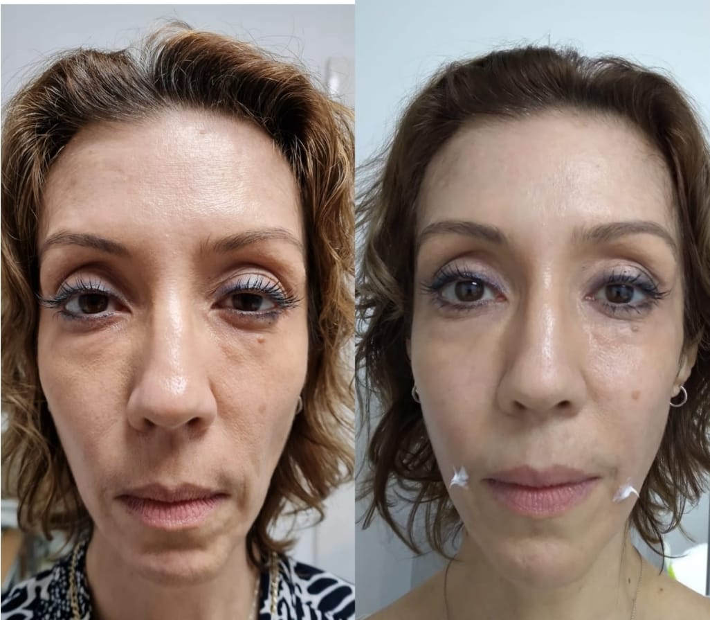 De age Treatment - Clínica Estética Carvajal Panamá 1