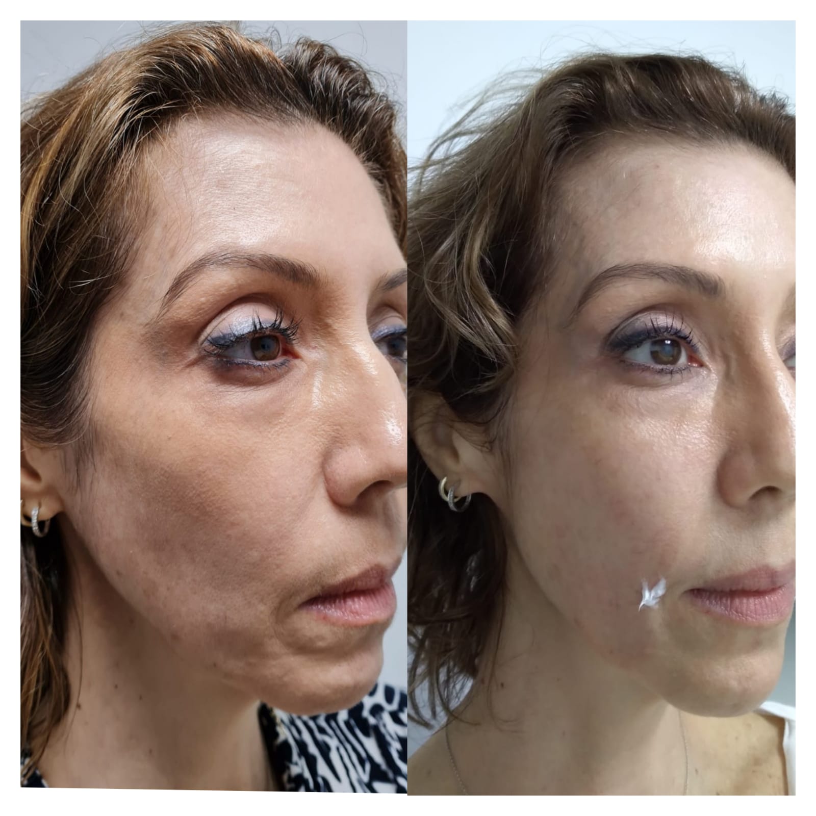 De age Treatment - Clínica Estética Carvajal Panamá 2