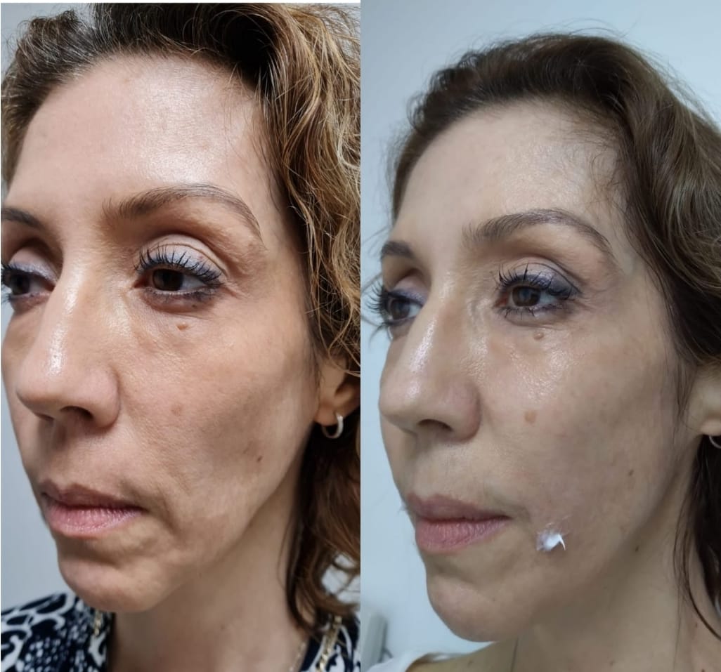 De age Treatment - Clínica Estética Carvajal Panamá 3