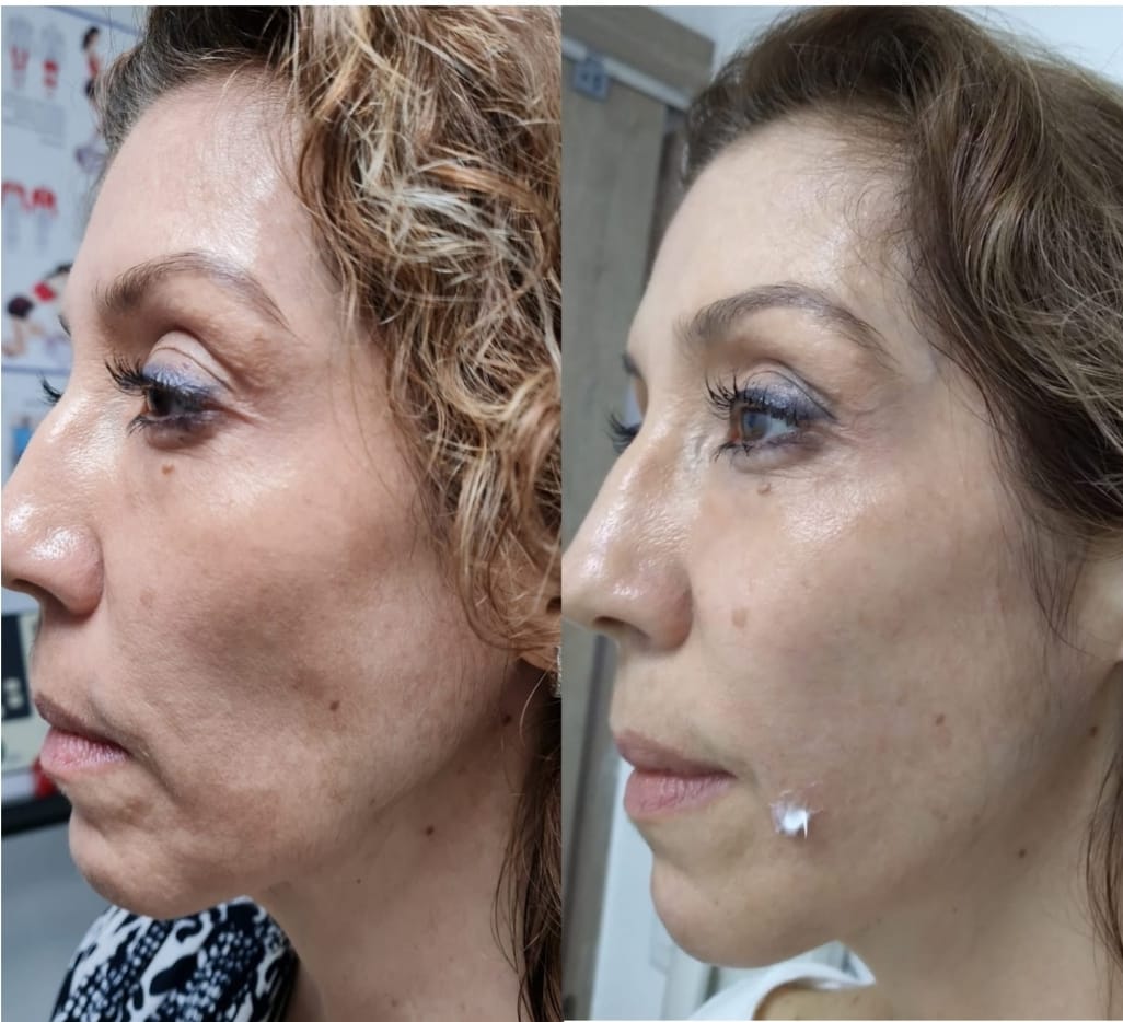 De age Treatment - Clínica Estética Carvajal Panamá 4