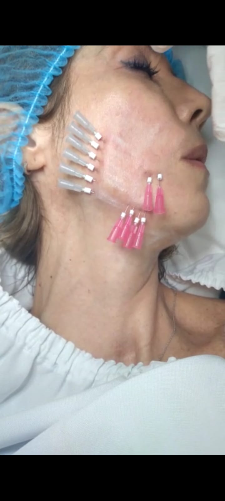 De age Treatment - Clínica Estética Carvajal Panamá 5