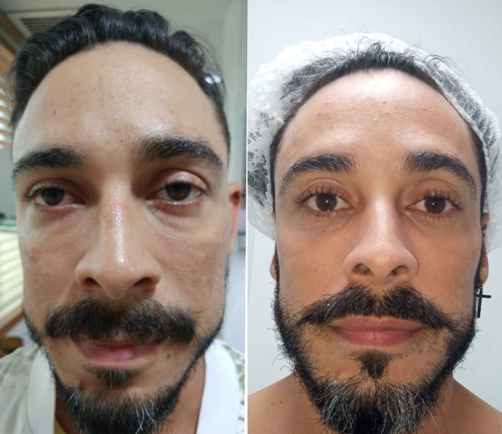 Fine Lift - Clínica Estética Carvajal Panamá 1