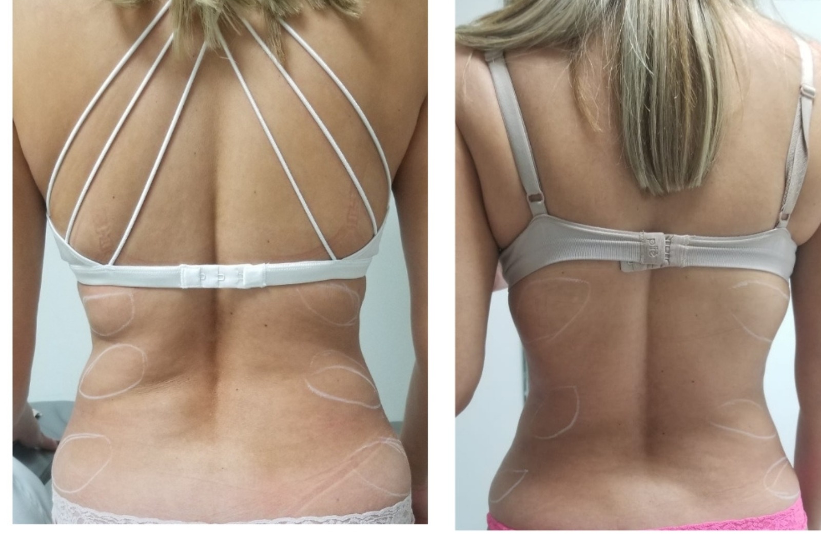 Sculpted Body - Clínica Estética Carvajal Panamá 3
