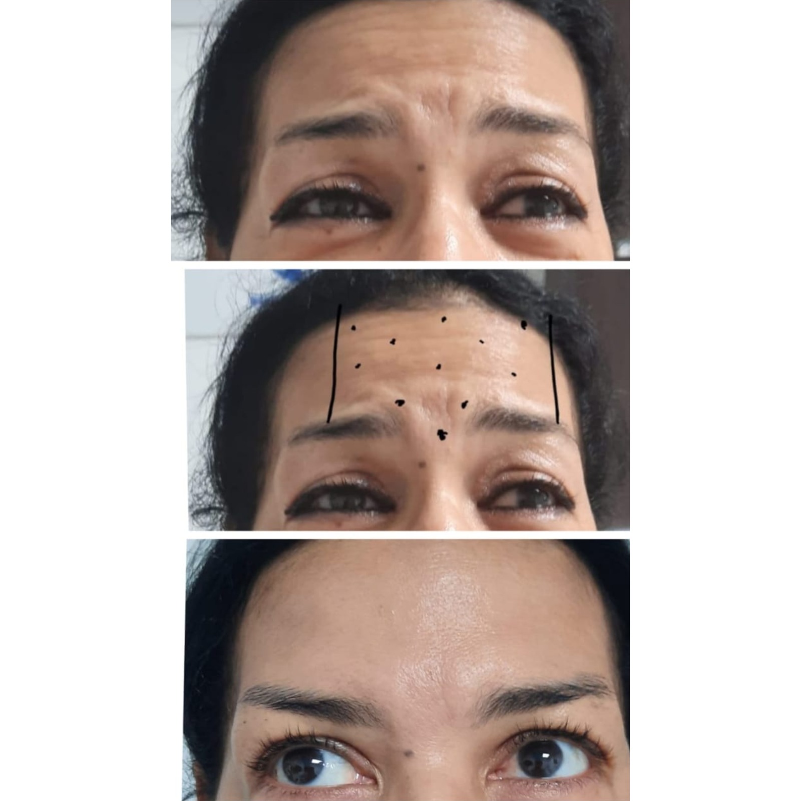 Toxina Botulínica - Clínica Estética Carvajal Panamá 3
