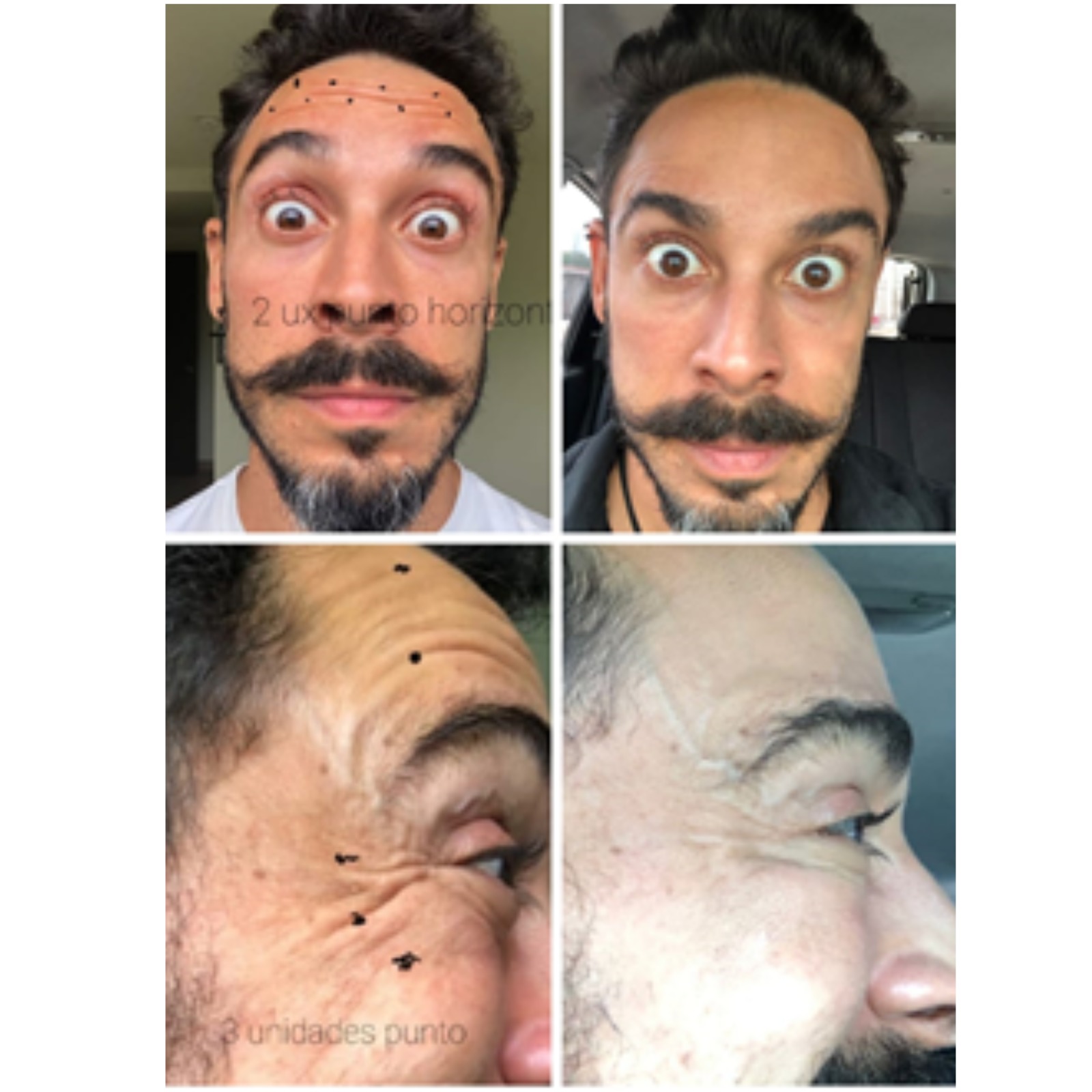 Toxina Botulínica - Clínica Estética Carvajal Panamá 4