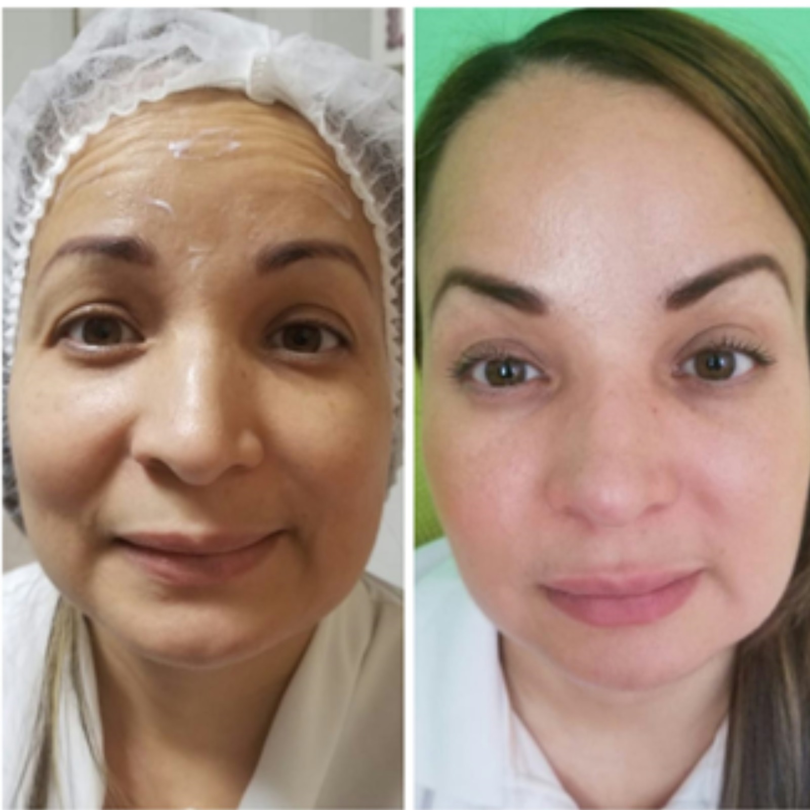 Toxina Botulínica - Clínica Estética Carvajal Panamá 1