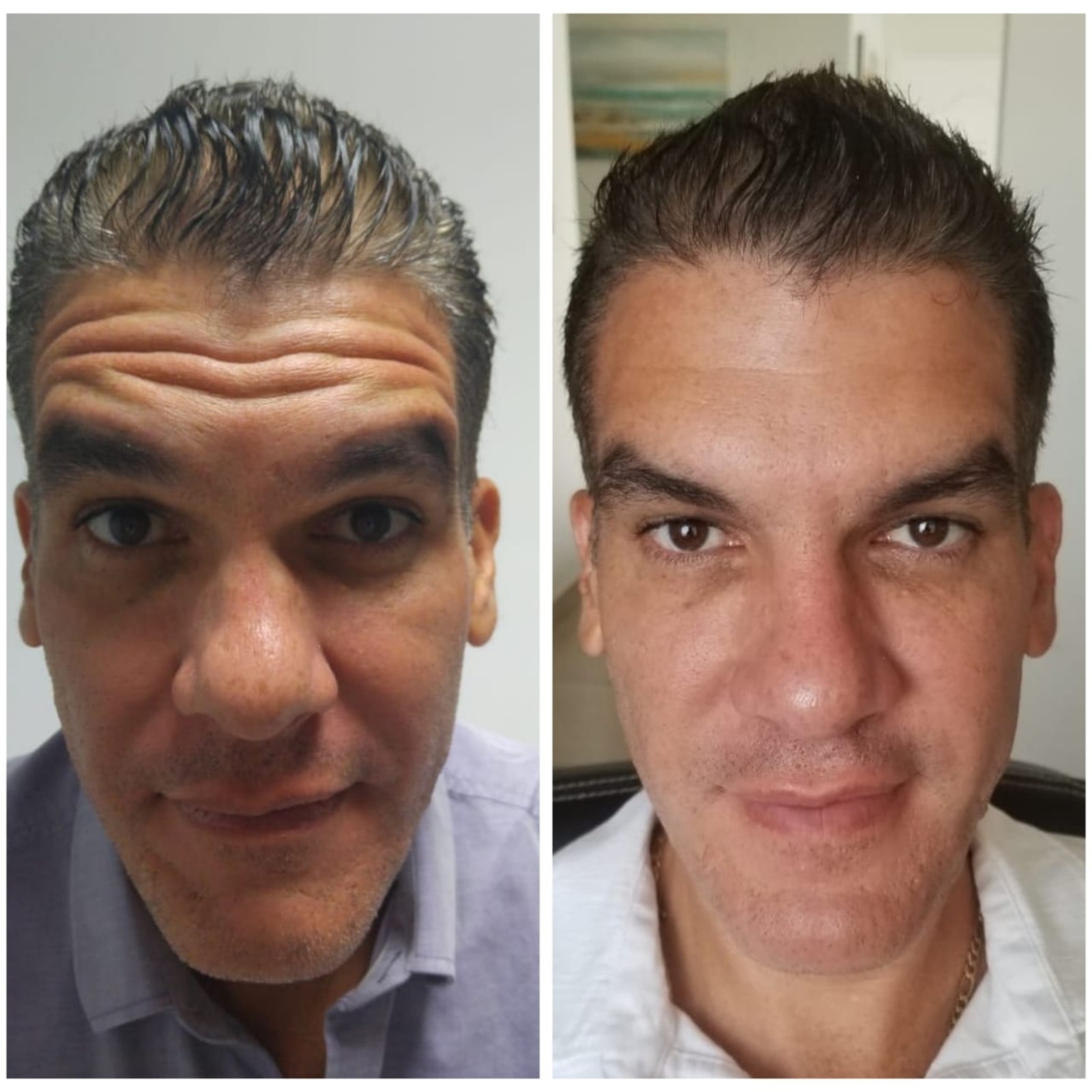 Toxina Botulínica - Clínica Estética Carvajal Panamá 2