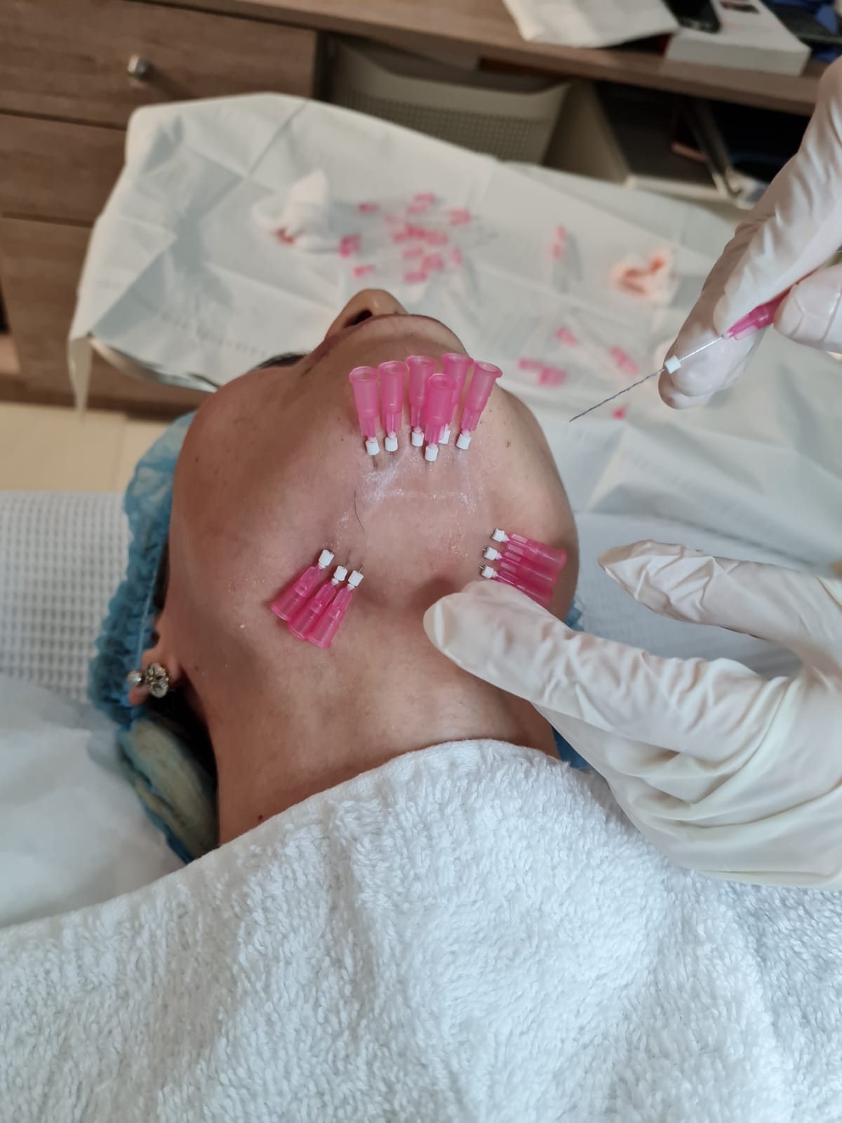 Hilo Monofilamento - Clínica Estética Carvajal Panamá 1