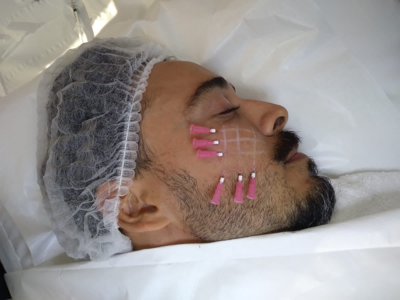 Hilo Monofilamento - Clínica Estética Carvajal Panamá 2