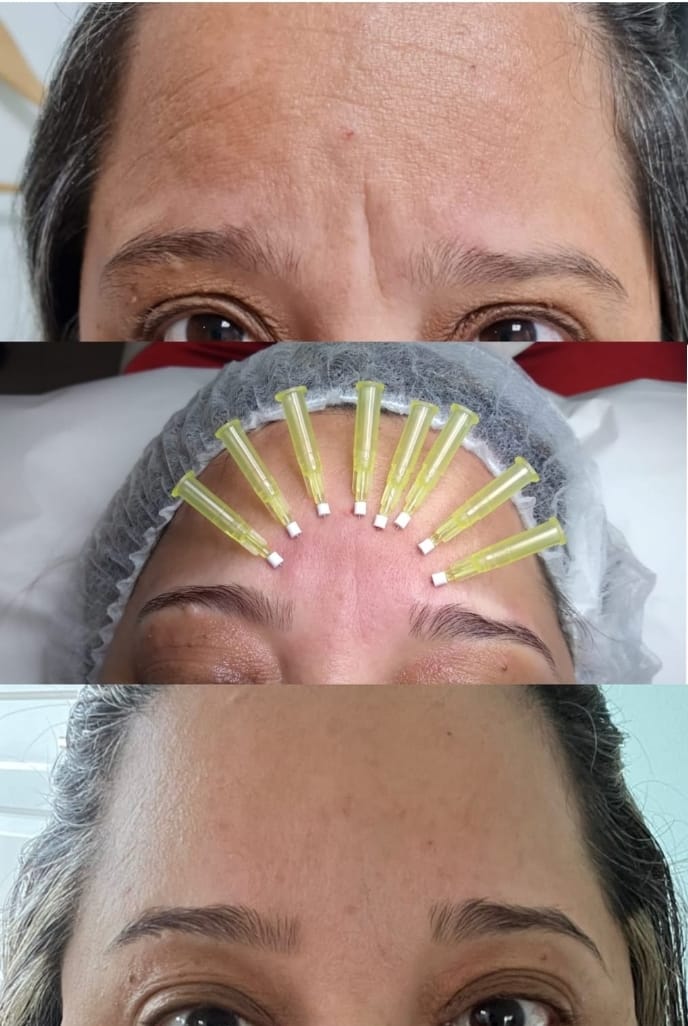 Hilo Monofilamento - Clínica Estética Carvajal Panamá 3