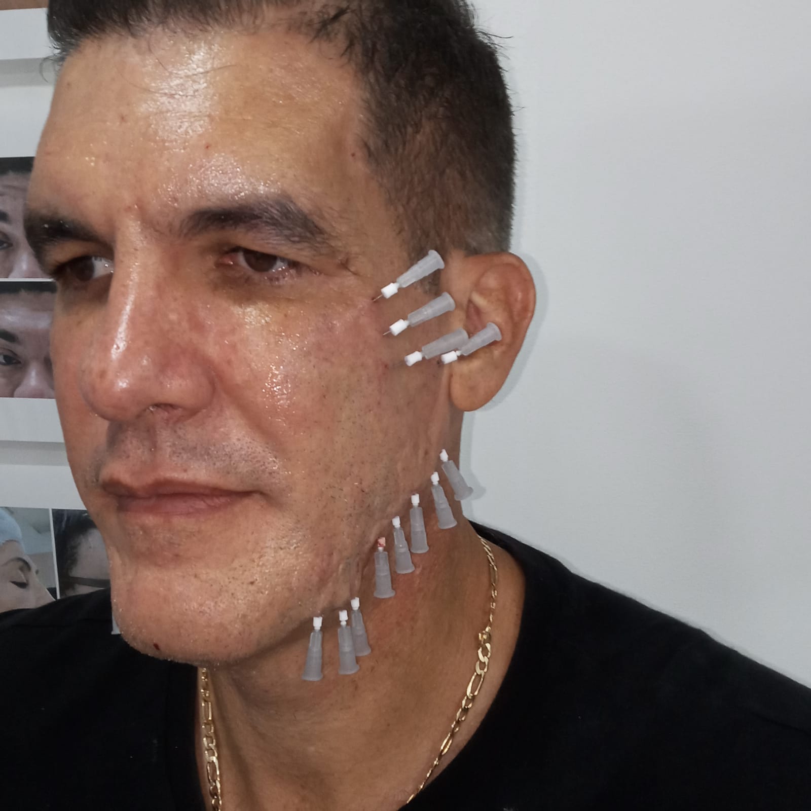 Hilos Screw - Clínica Estética Carvajal Panamá 3