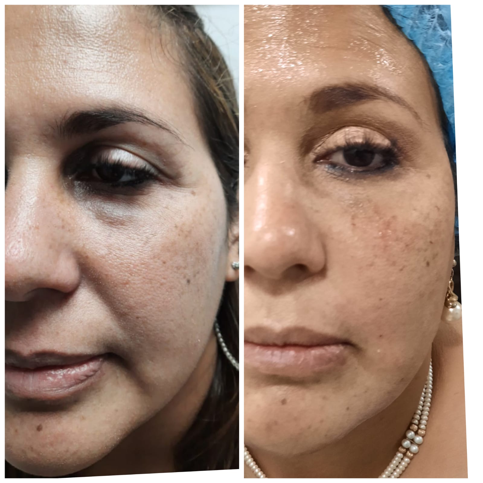 Total Lift - Clínica Estética Carvajal Panamá 1