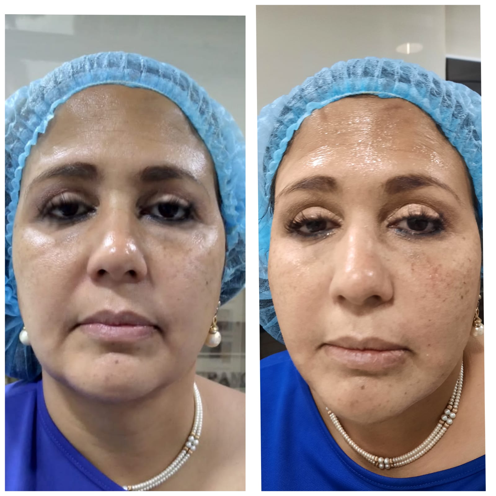 Total Lift - Clínica Estética Carvajal Panamá 2