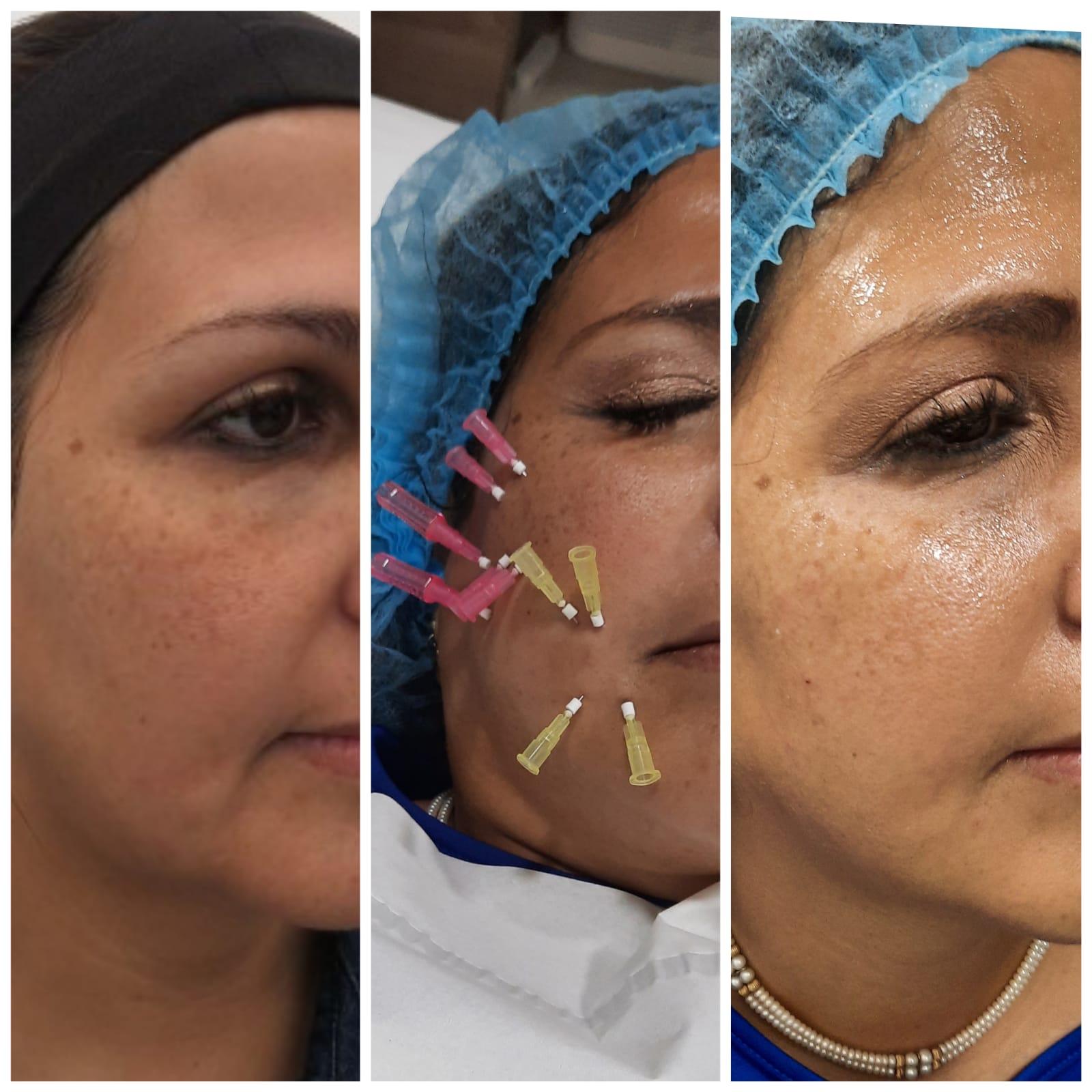 Total Lift - Clínica Estética Carvajal Panamá 3