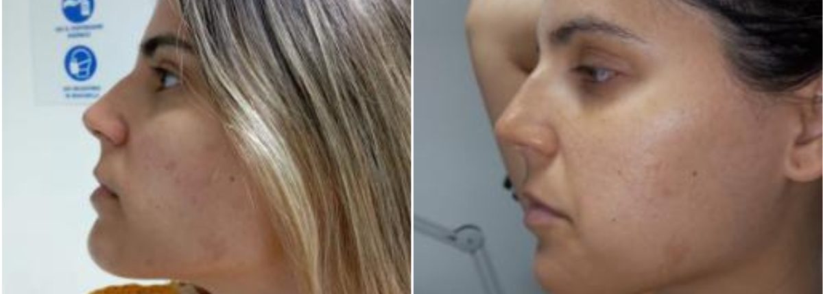 Tratamiento de Novia - Clínica Estética Carvajal Panamá 4