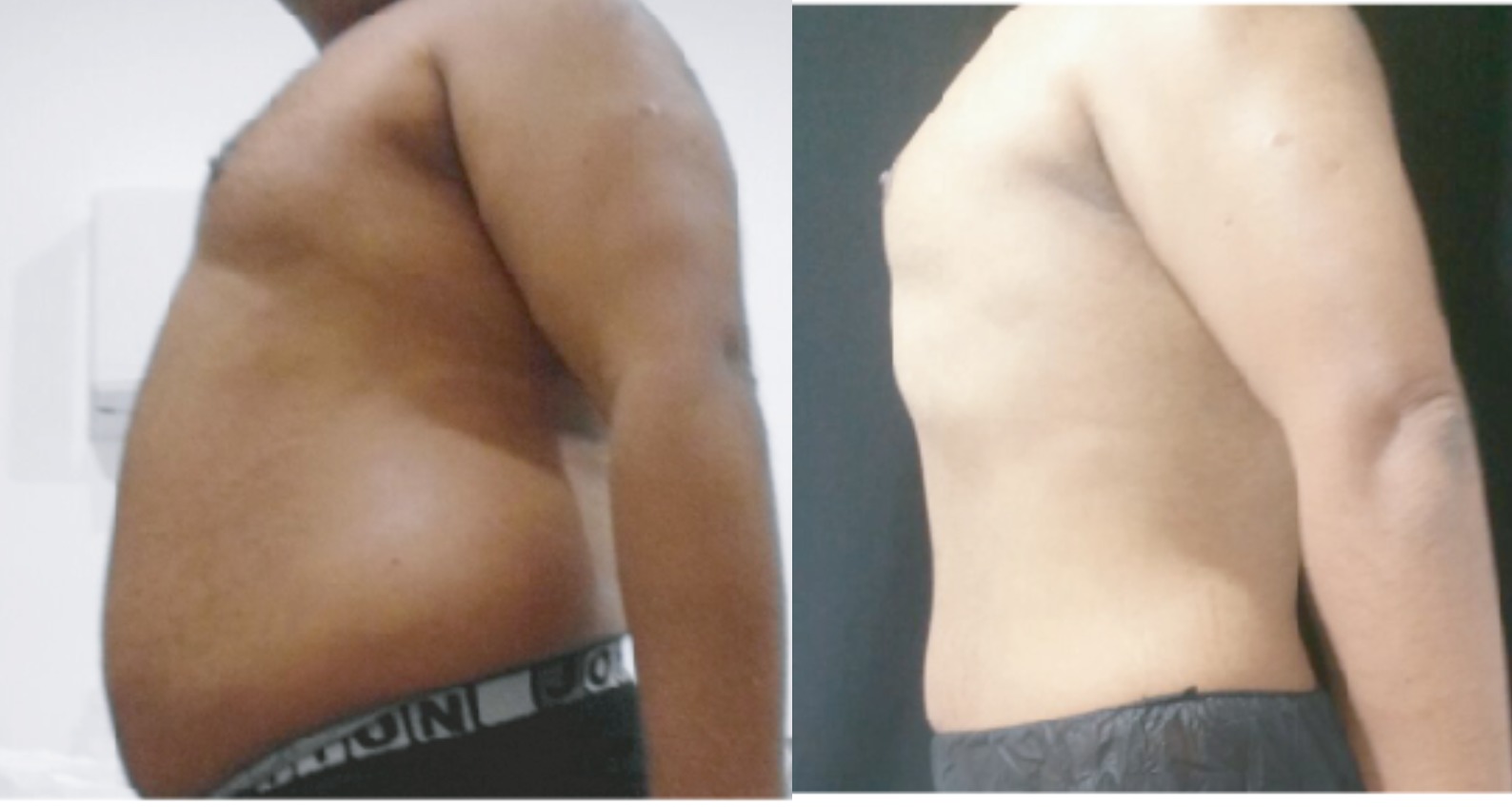 Exilis Cuerpo por Área - Clínica Estética Carvajal Panamá 2