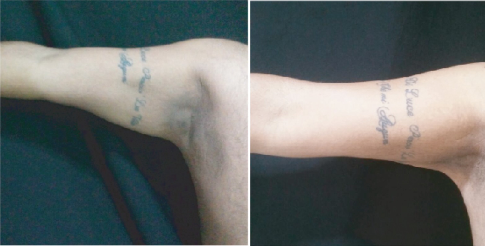 Exilis Cuerpo por Área - Clínica Estética Carvajal Panamá 3