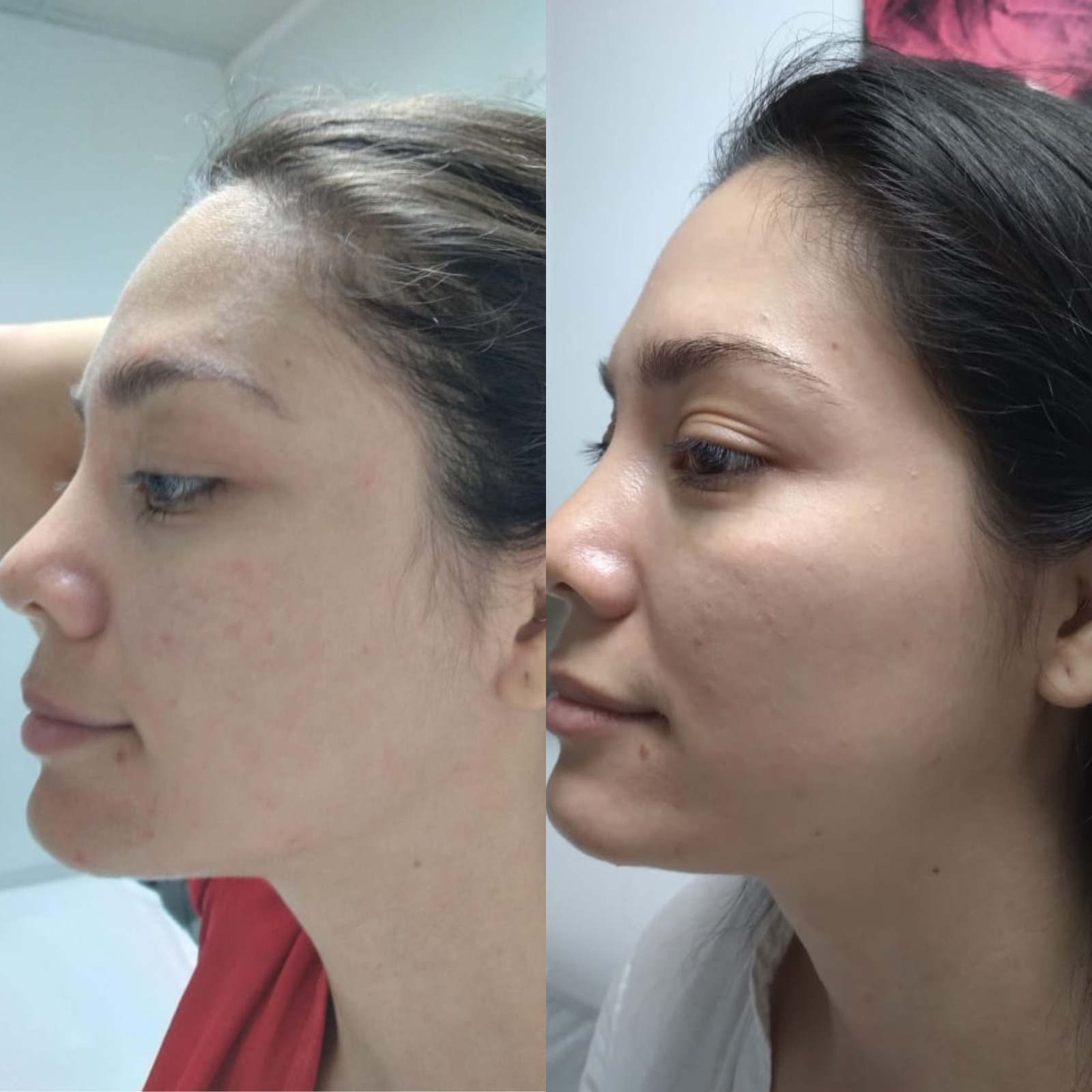 Plasma - Clínica Estética Carvajal Panamá 2