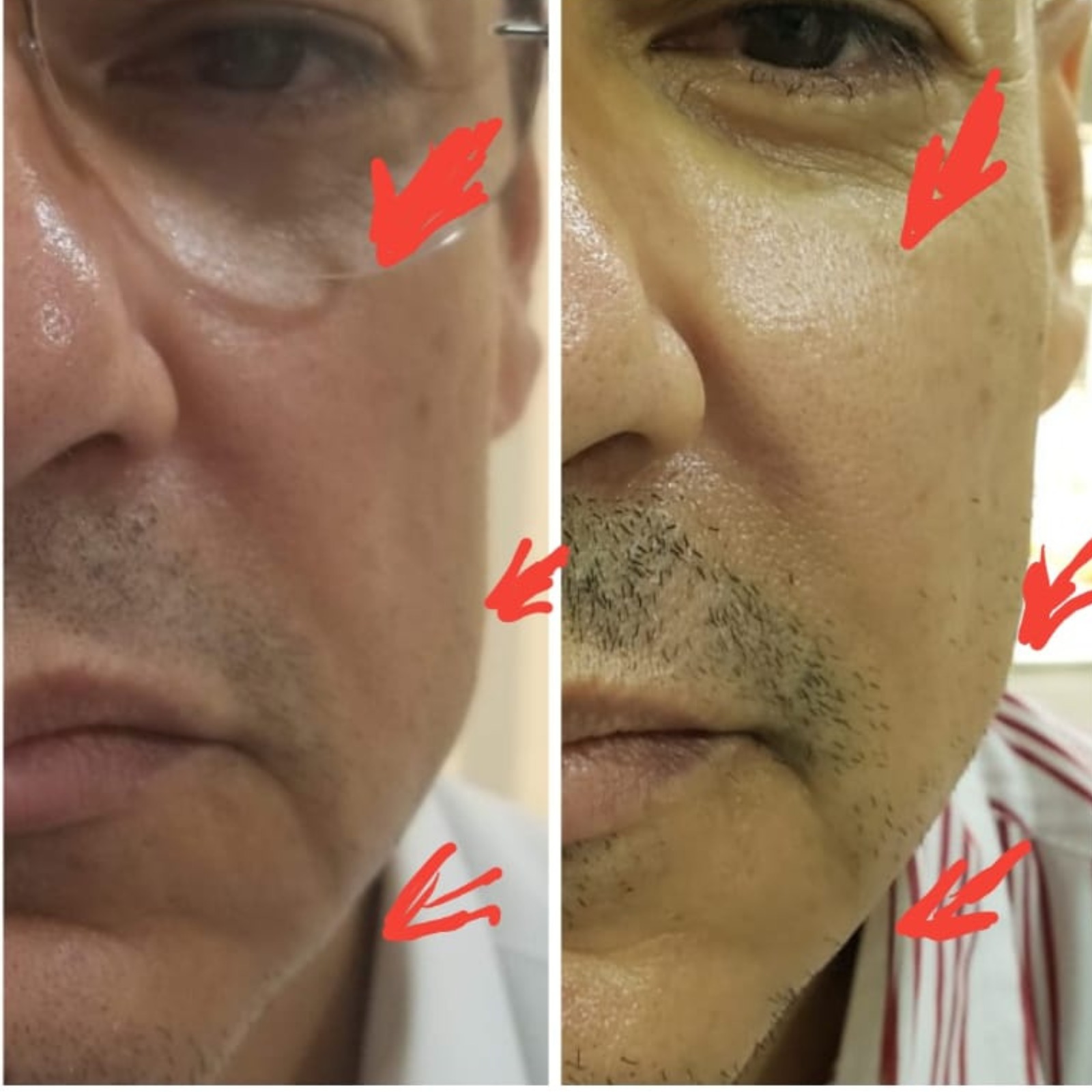 Relleno Face Shape - Clínica Estética Carvajal Panamá 2