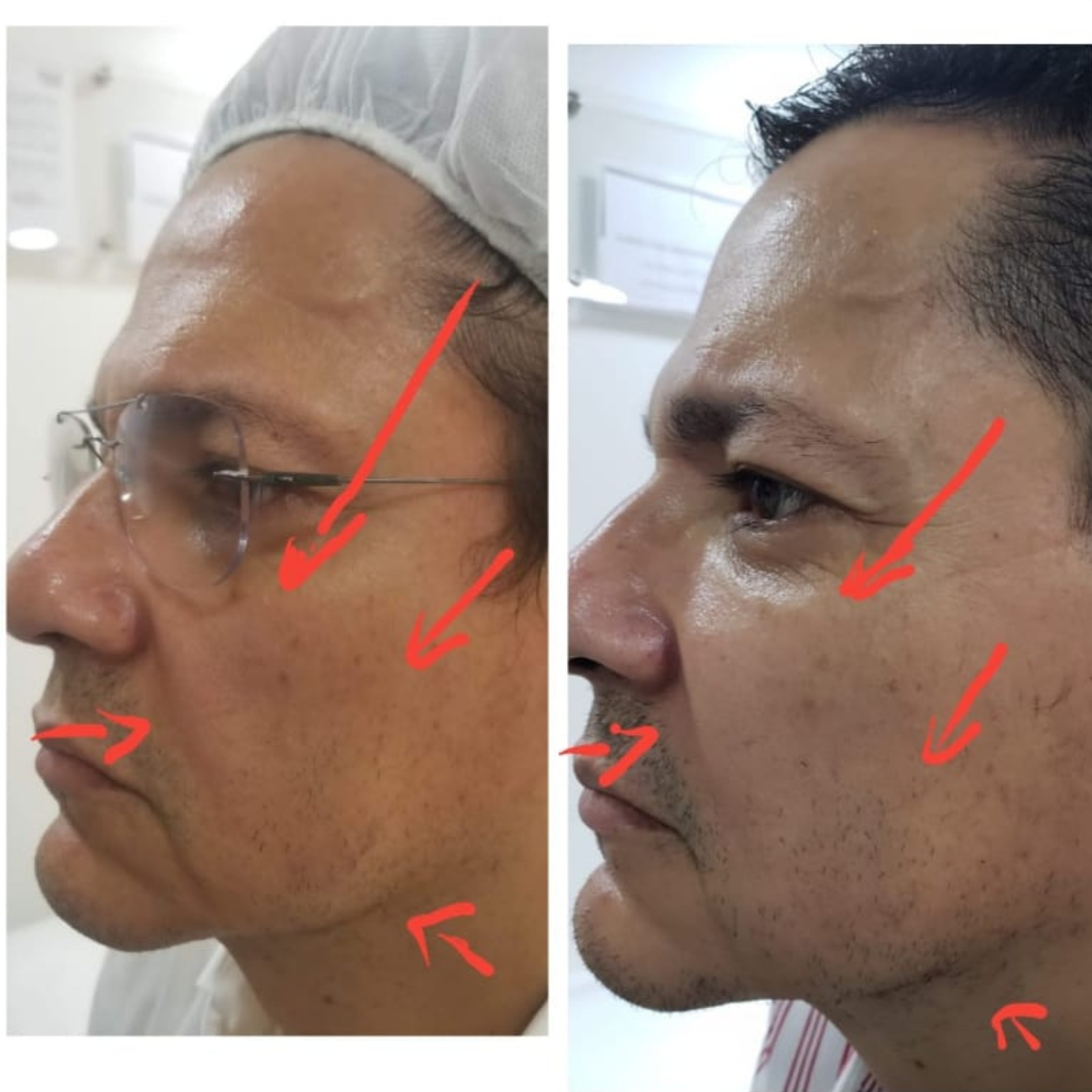 Relleno Face Shape - Clínica Estética Carvajal Panamá 3