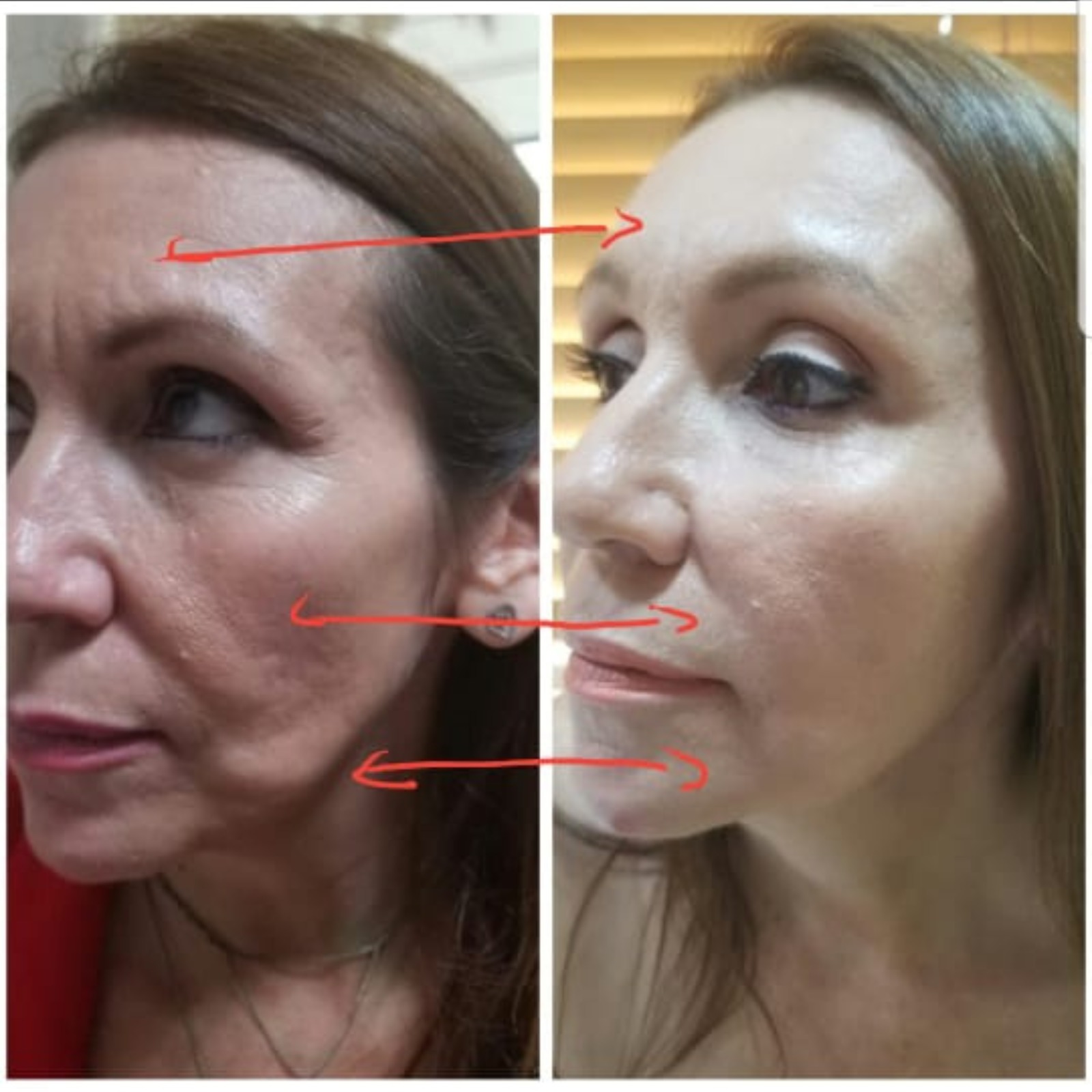 HIFU Rostro - Clínica Estética Carvajal Panamá 2