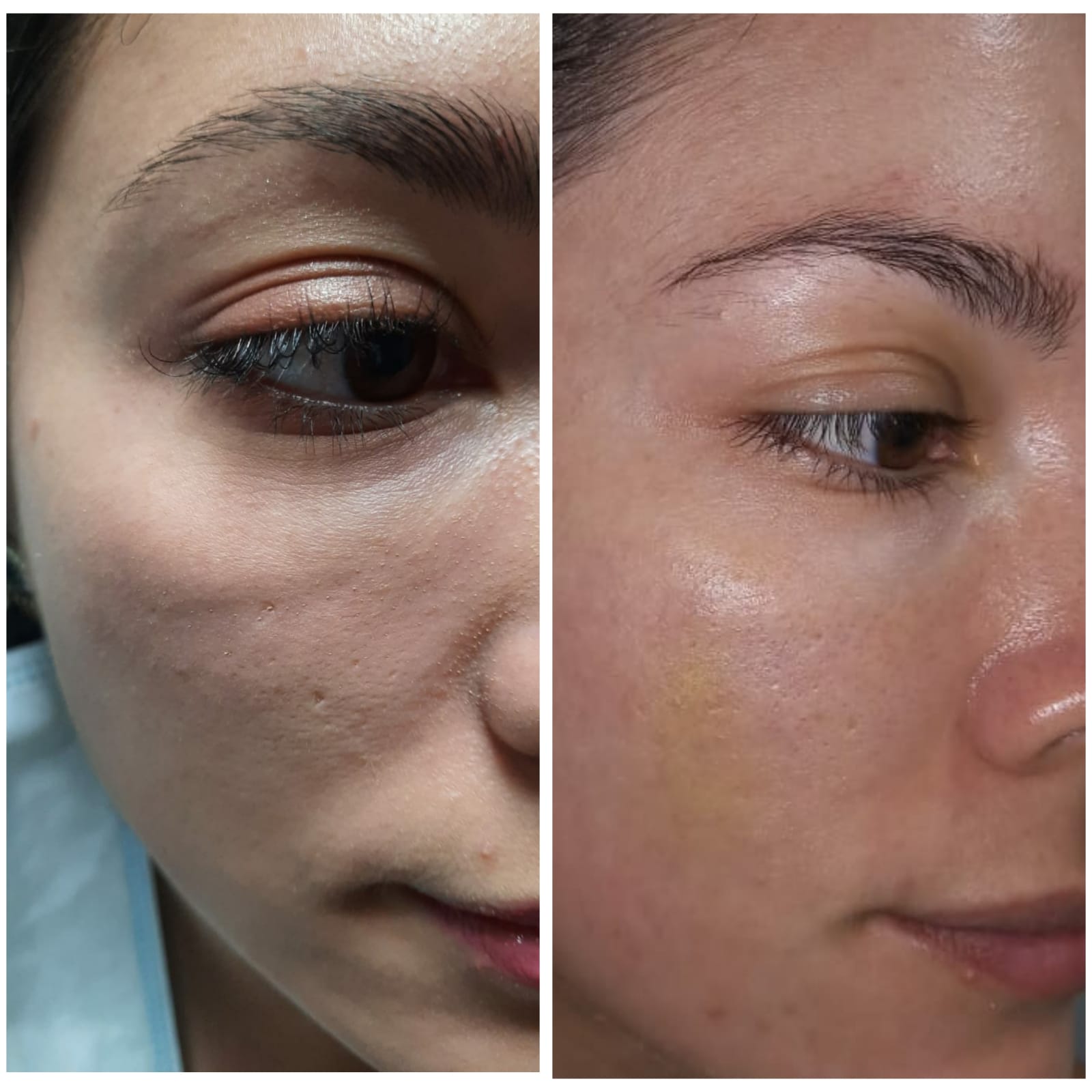 Hilos Screw - Clínica Estética Carvajal Panamá 1