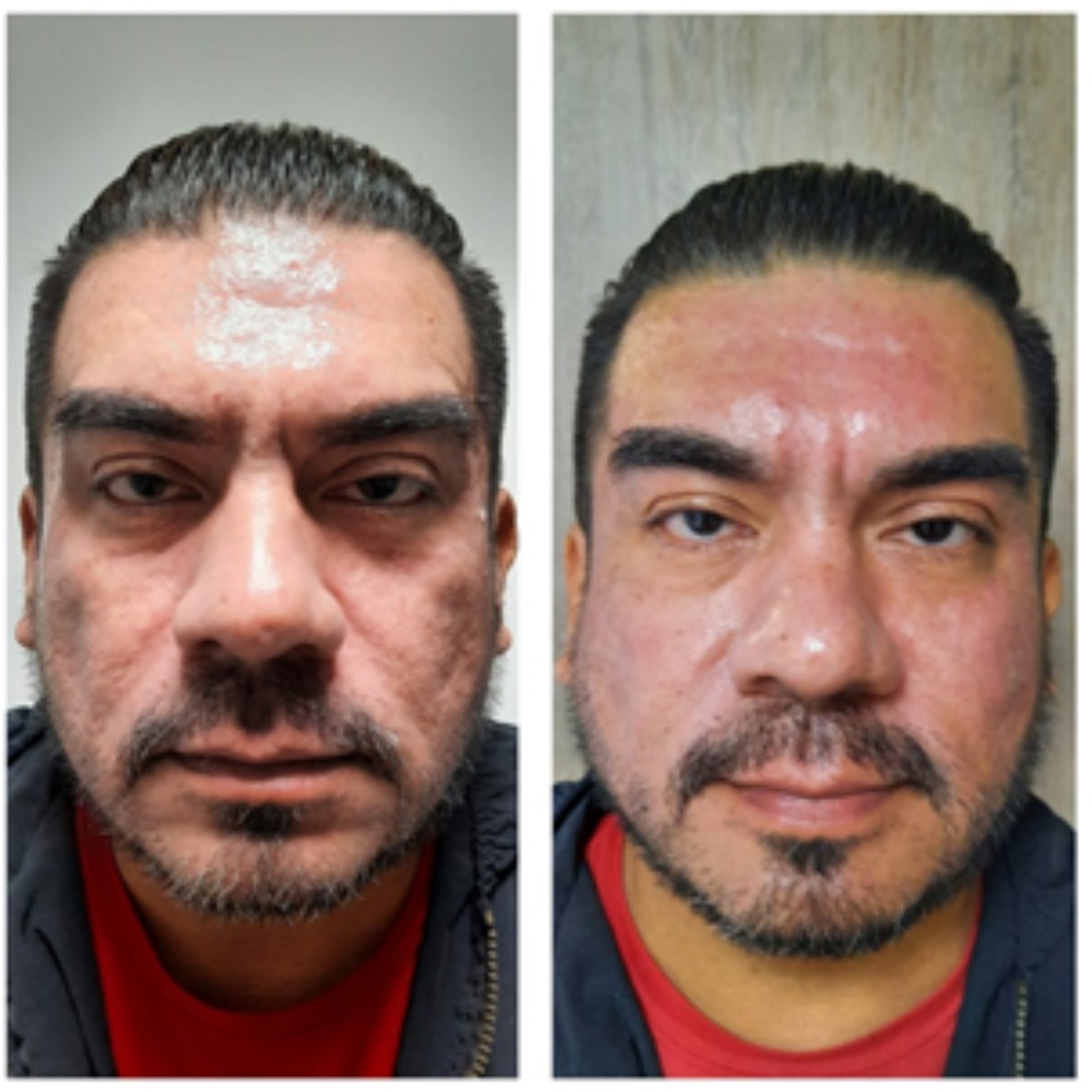Plasma Gel - Clínica Estética Carvajal Panamá 2