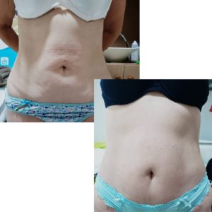 Post Parto - Clínica Estética Carvajal Panamá 2