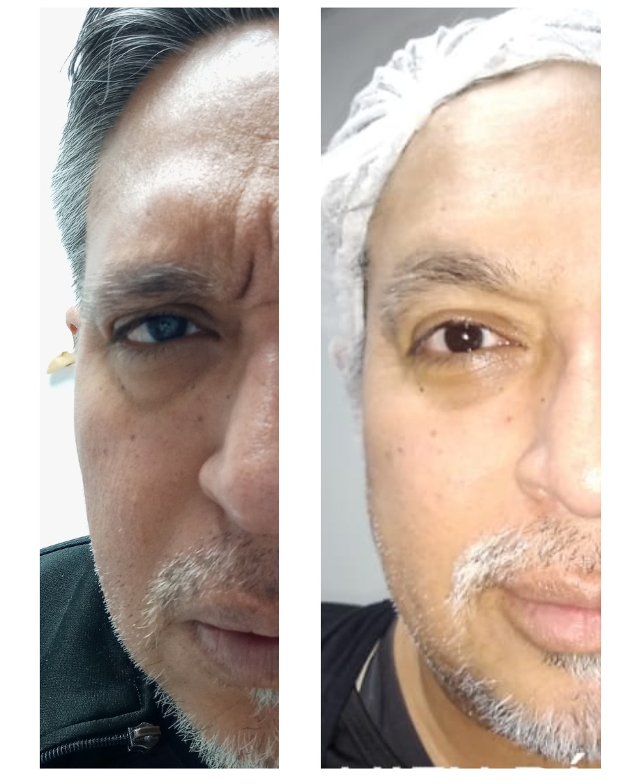 HIFU Párpados - Clínica Estética Carvajal Panamá 2