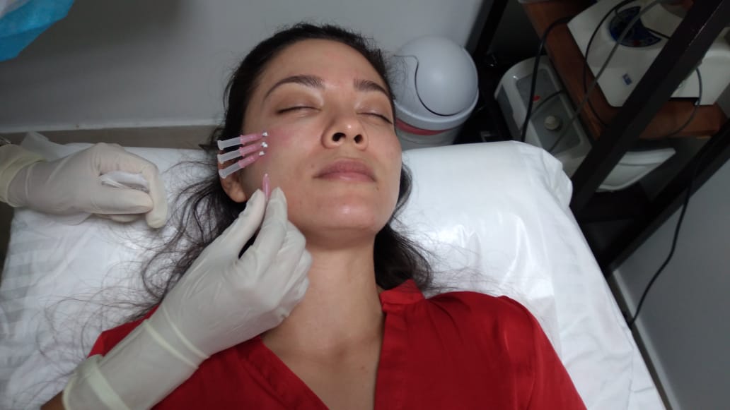 Hilos Screw - Clínica Estética Carvajal Panamá 2